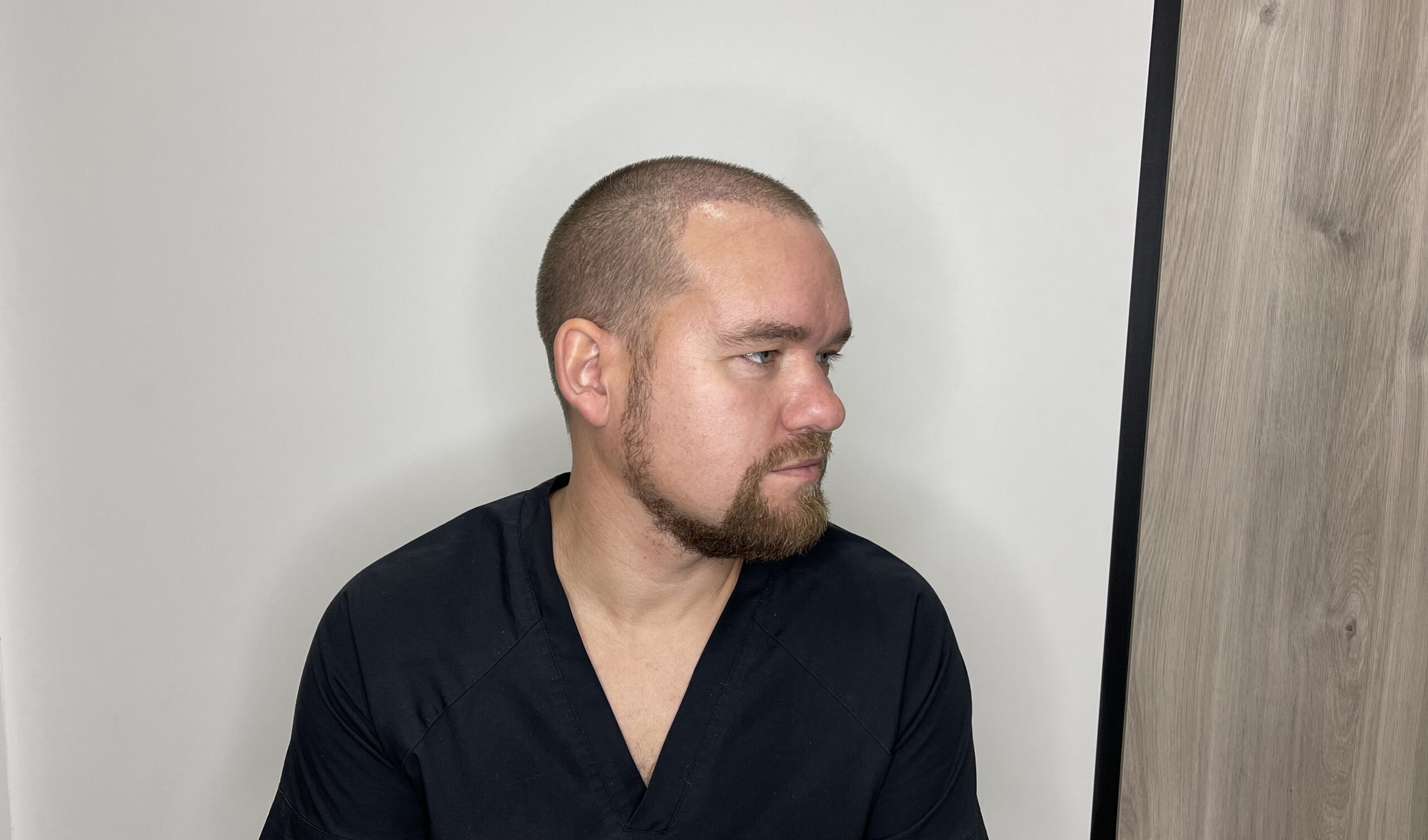 FIRST MONTH AFTER HAIR TRANSPLANTATION FUE METHOD