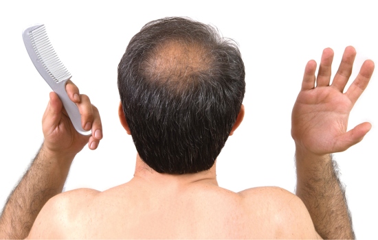IS IT POSSIBLE TO GET RID OF BALD HEAD