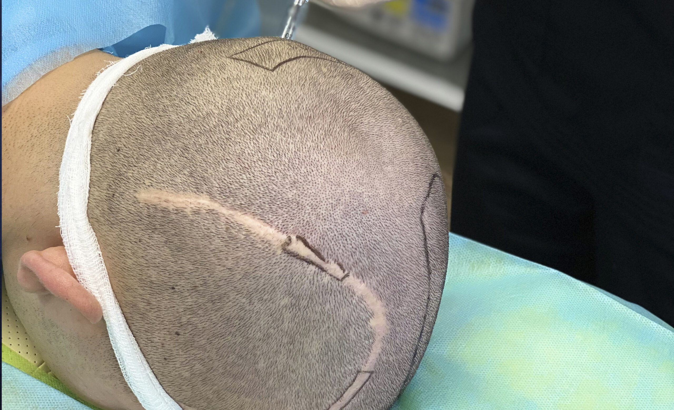 Hair transplantation in scar tissue